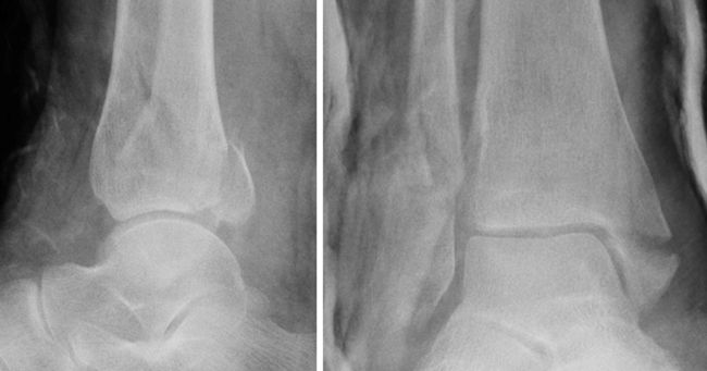 Ankle Stability in Ankle Fractures