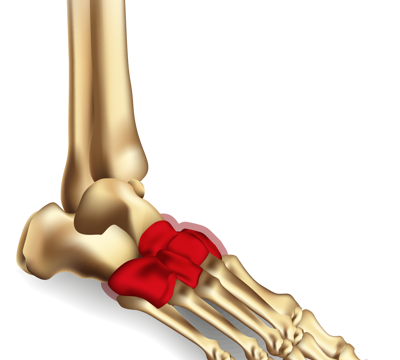 For Midfoot