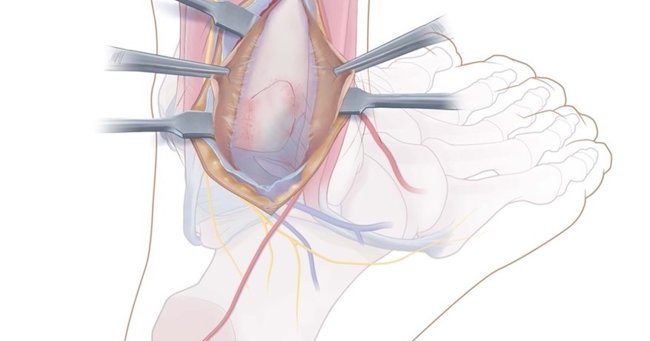 Anatomy of the Insertion of the PITFL and the Posterior Malleolar Fracture