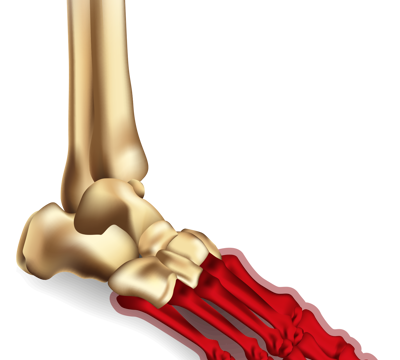 For Forefoot