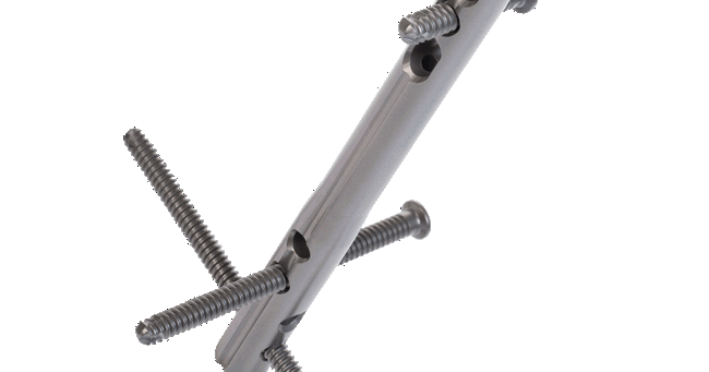 OxBridge™ Ankle Fusion Nail