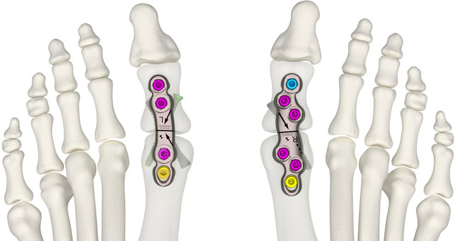 Archived IFU - Volition Plating System (UK)