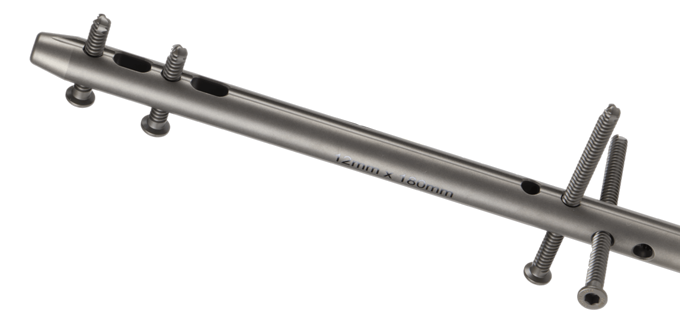 Oxbridge™ Ankle Fusion Nail