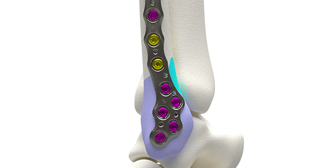Volition™ Ankle Fracture plating system