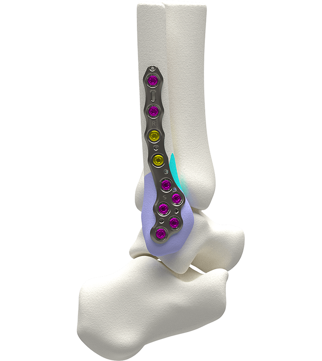 Volition fibular plate
