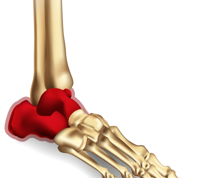 Ankle Fracture  Simcoe-Muskoka Orthopaedics