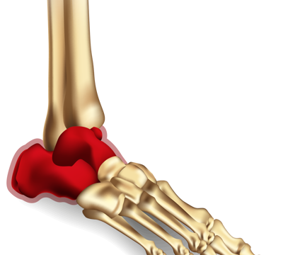 For Hindfoot