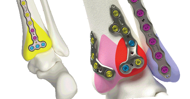 UDI Cross Reference Sheets – Volition Ankle Fracture