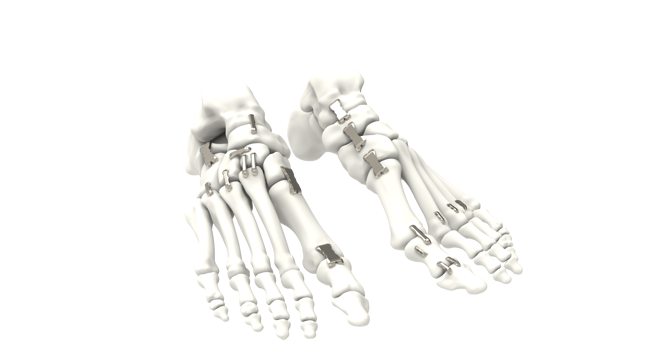 COGNiTiON™ Staple System Surgical Technique