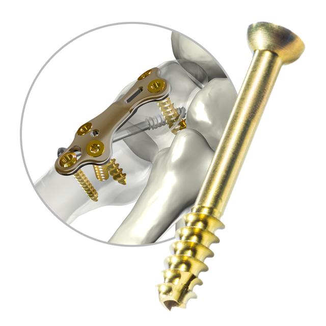 Cannulated Compression Screw