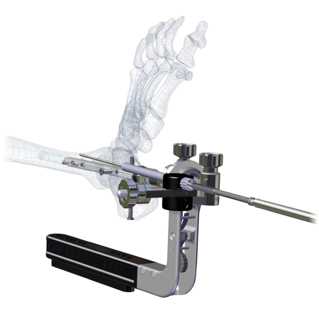 Miss-A-Nail™ Screw Option