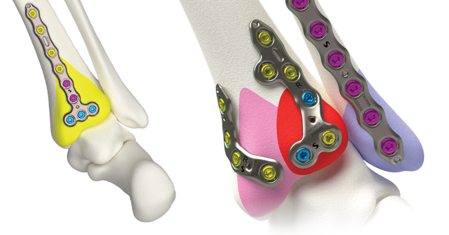 Volition® Ankle Fracture Plating