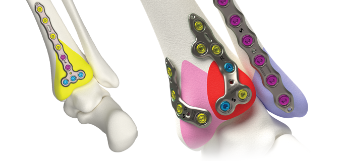 Volition® Ankle Fracture Plating
