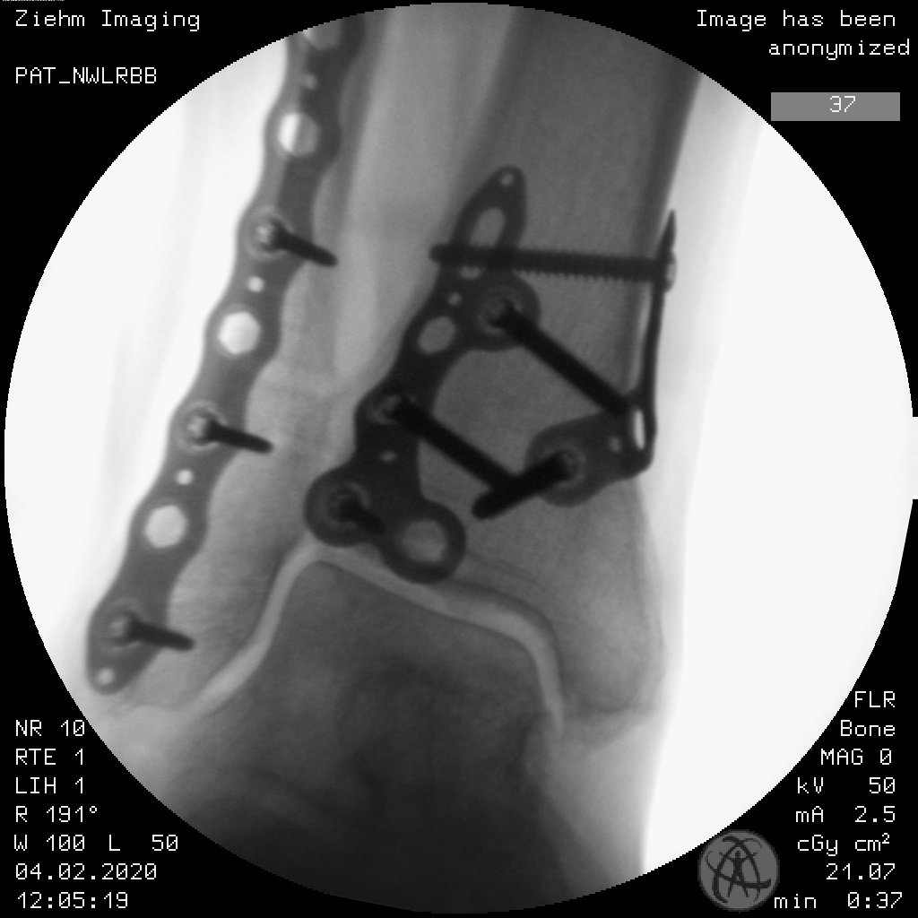 2A 2B Volition Plate X Ray