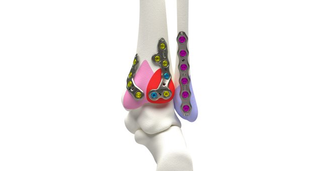 Management of Trimalleolar Ankle Fractures