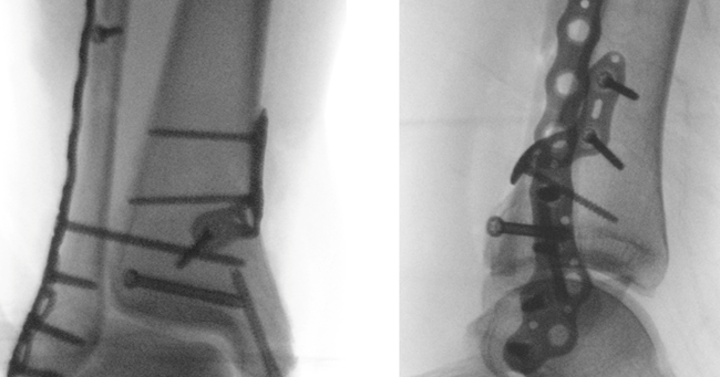 Does Functional Outcome Depend on Fracture Quality