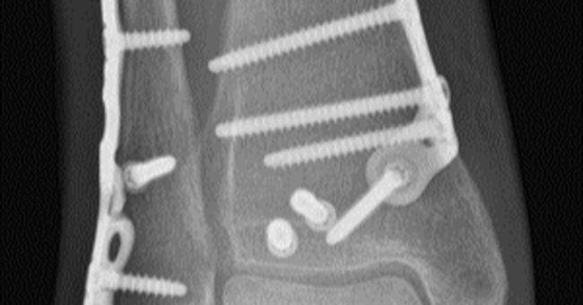 Fragment-Specific Fixation for Tri-malleolar Fractures - Functional and Radiological Outcomes