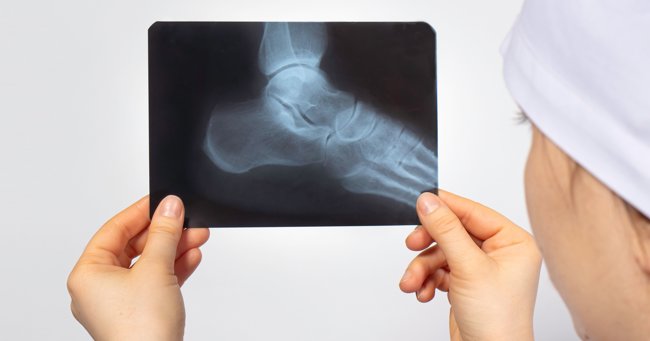 Correction Of Hindfoot Deformity In Charcot Neuroarthopathy